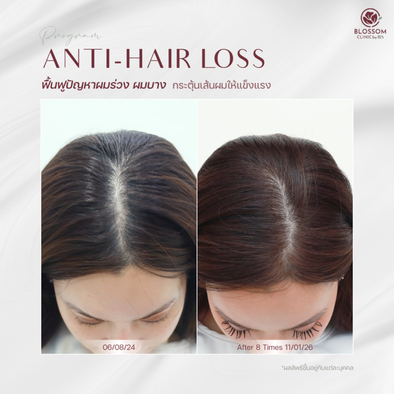 ผลลัพธ์หลังรับบริการโปรแกรม Anti-Hair Loss ที่ Blossom Clinic by BLS