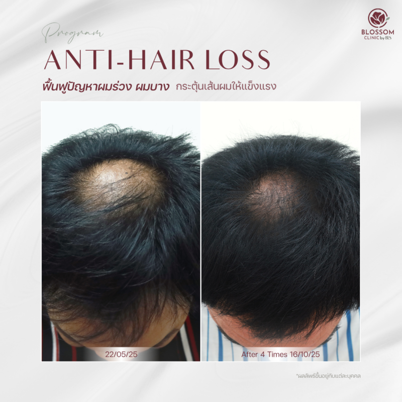 รีวิวโปรแกรม Anti-Hair Loss