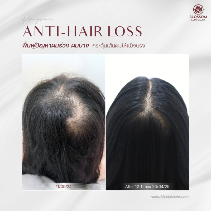 ผลลัพธ์หลังรับบริการโปรแกรม Anti-Hair Loss ที่ Blossom Clinic by BLS