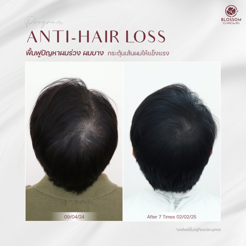 ผลลัพธ์หลังรับบริการโปรแกรม Anti-Hair Loss ที่ Blossom Clinic by BLS