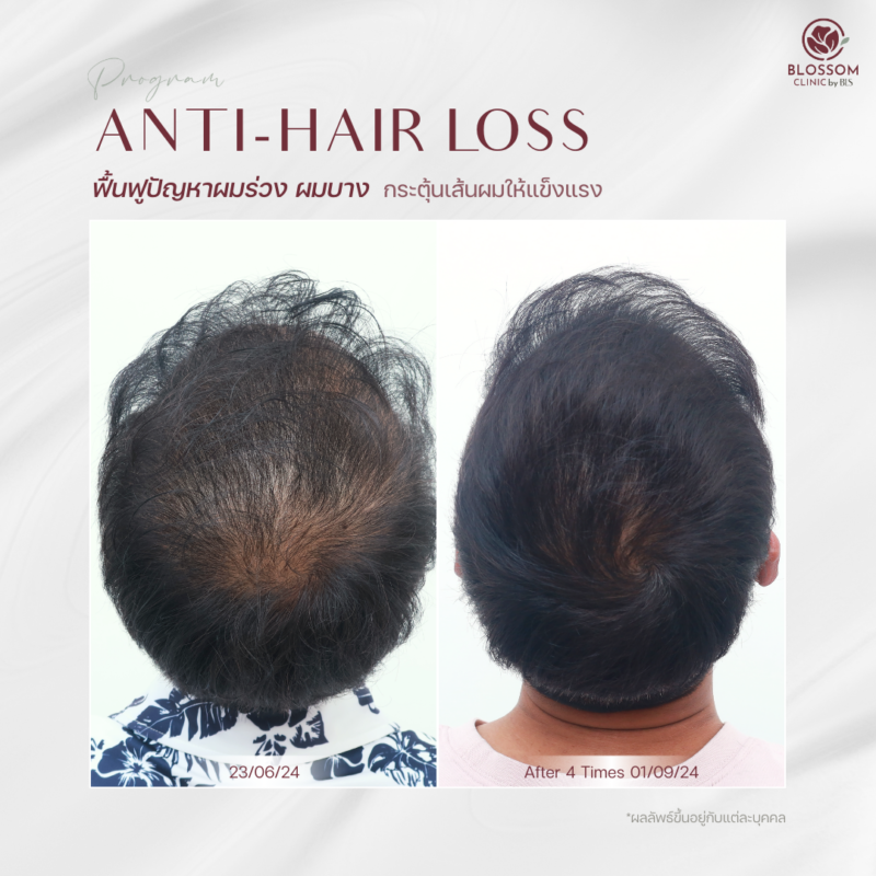 รีวิวโปรแกรม Anti-Hair Loss