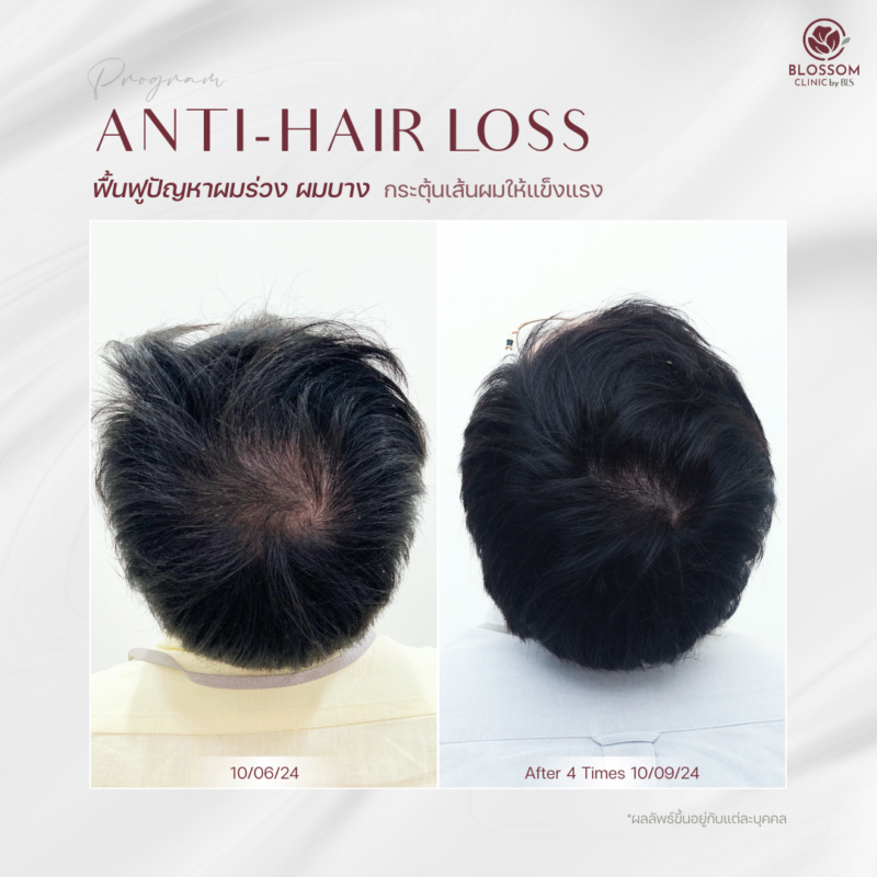 รีวิวโปรแกรม Anti-Hair Loss