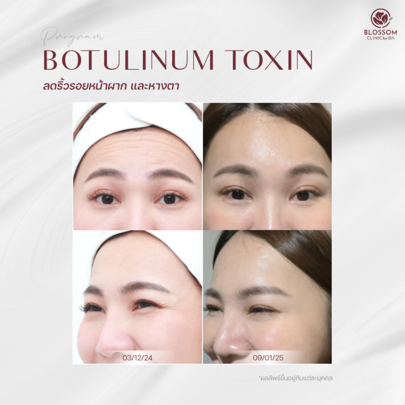 ผลลัพธ์หลังรับบริการ ที่ Blossom Clinic by BLS