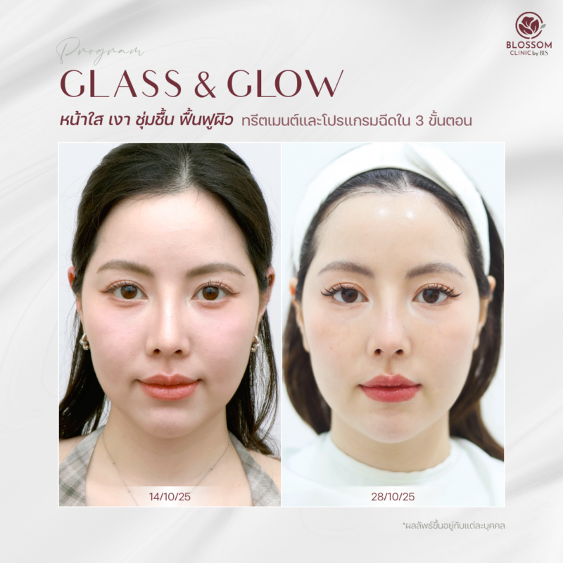 รีวิวโปรแกรม Glass & Glow