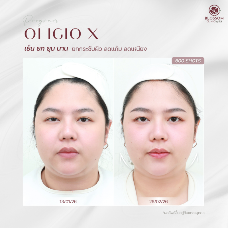 ผลลัพธ์หลังรับบริการ Program Oligio X ที่ Blossom Clinic by BLS
