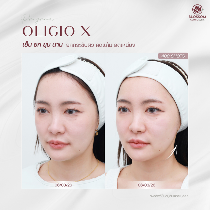 รีวิวโปรแกรม Oligio X