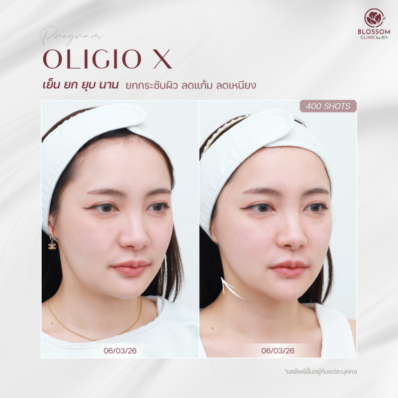 ผลลัพธ์หลังรับบริการ Program Oligio X ที่ Blossom Clinic by BLS
