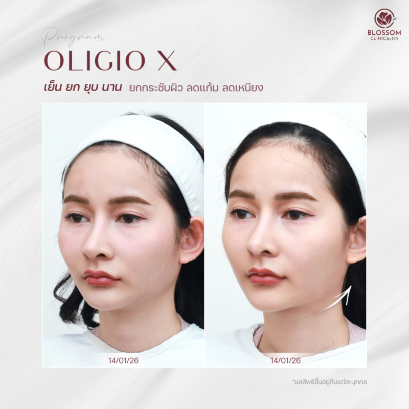 รีวิวโปรแกรม Oligio X