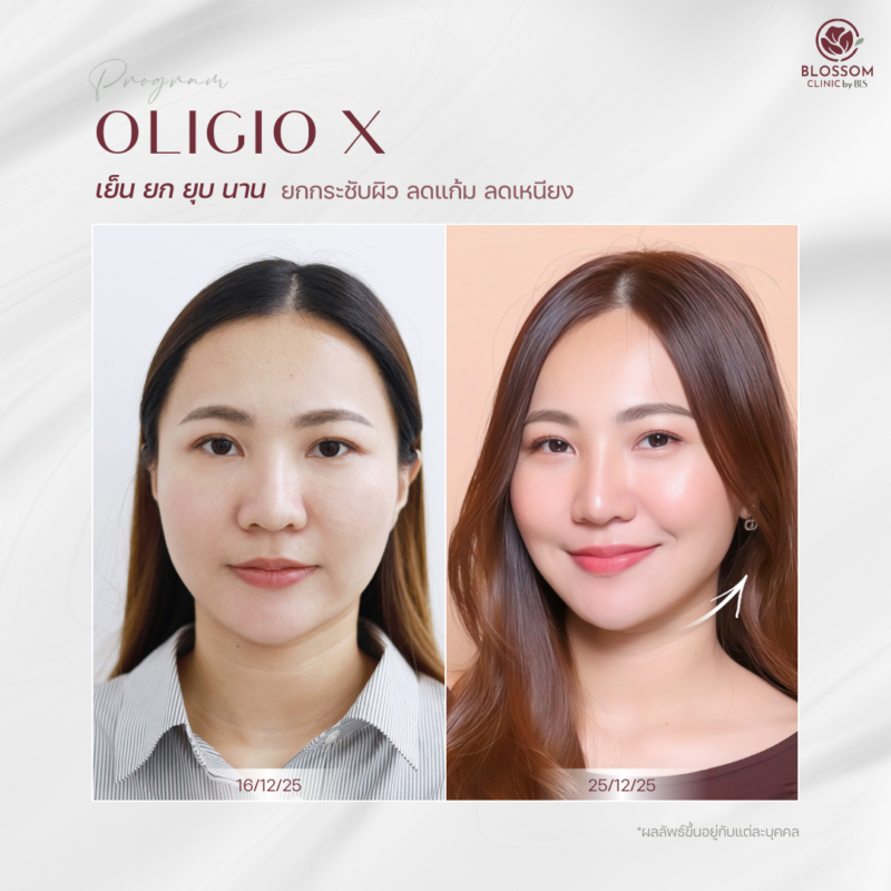รีวิวโปรแกรม Oligio X