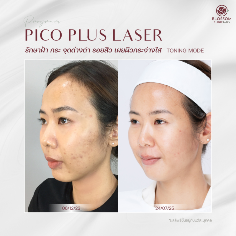ผลลัพธ์หลังรับบริการ Program Pico Laser ที่ Blossom Clinic by BLS