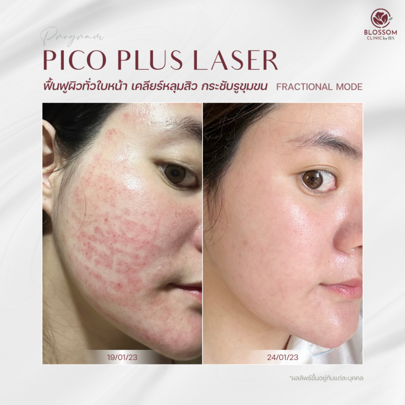 ผลลัพธ์หลังรับบริการ Program Pico Laser ที่ Blossom Clinic by BLS
