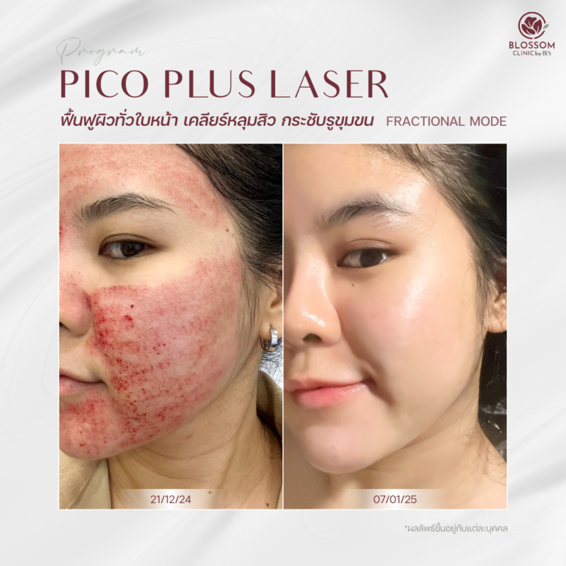 ผลลัพธ์หลังรับบริการ Program Pico Laser ที่ Blossom Clinic by BLS