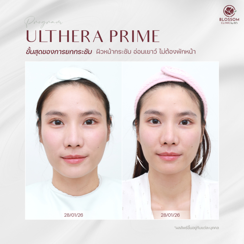 รีวิวโปรแกรม Ulthera Prime