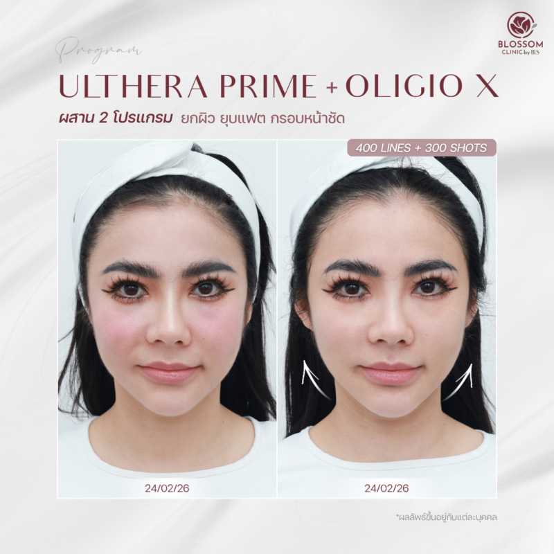 รีวิวโปรแกรม Ulthera Prime