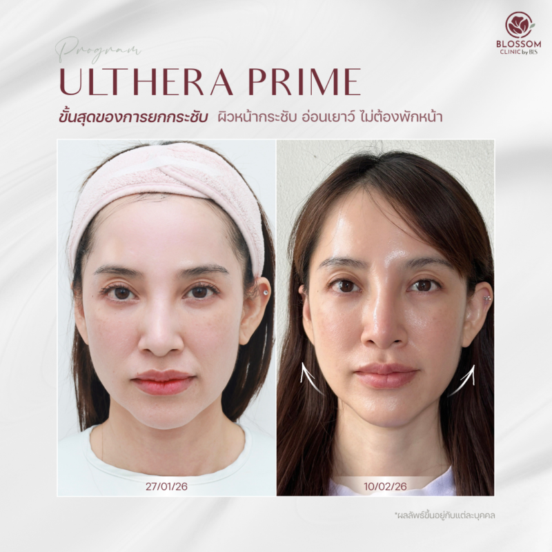 รีวิวโปรแกรม Ulthera Prime
