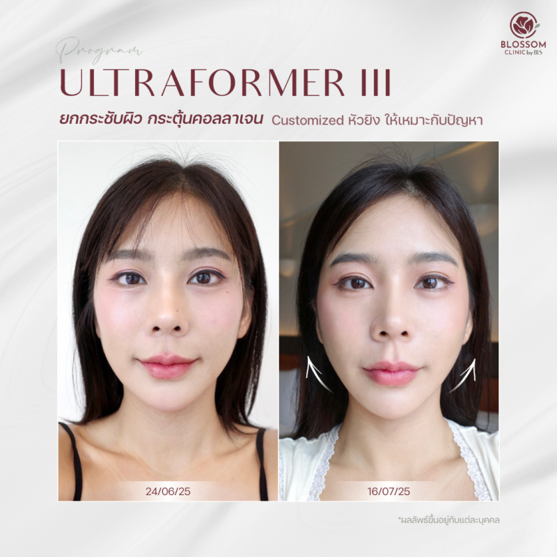 รีวิวโปรแกรม Ultraformer III