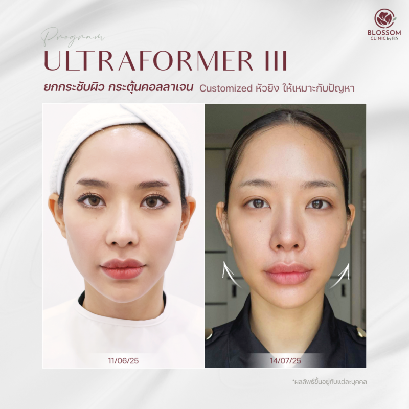 รีวิวโปรแกรม Ultraformer III