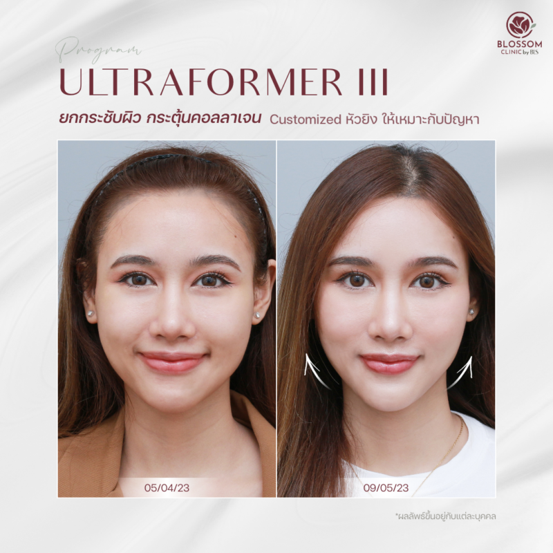 รีวิวโปรแกรม Ultraformer III