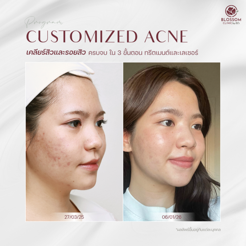 รีวิว Program Customized Skin Treatment ที่ Blossom Clinic