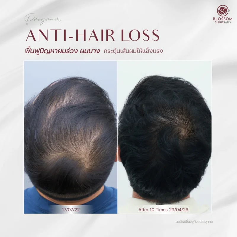 รีวิวโปรแกรม Anti-Hair Loss