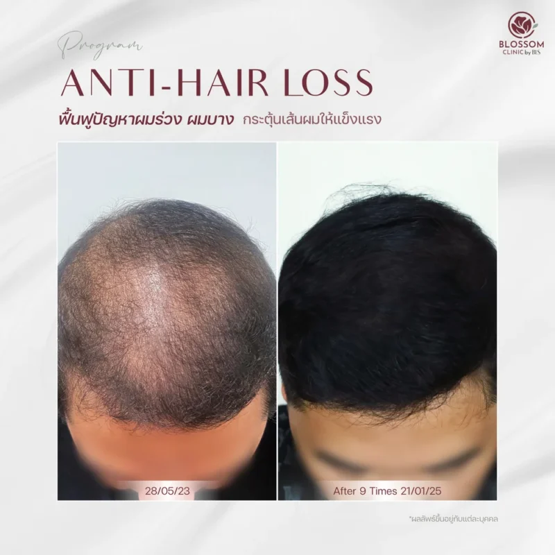 รีวิวโปรแกรม Anti-Hair Loss