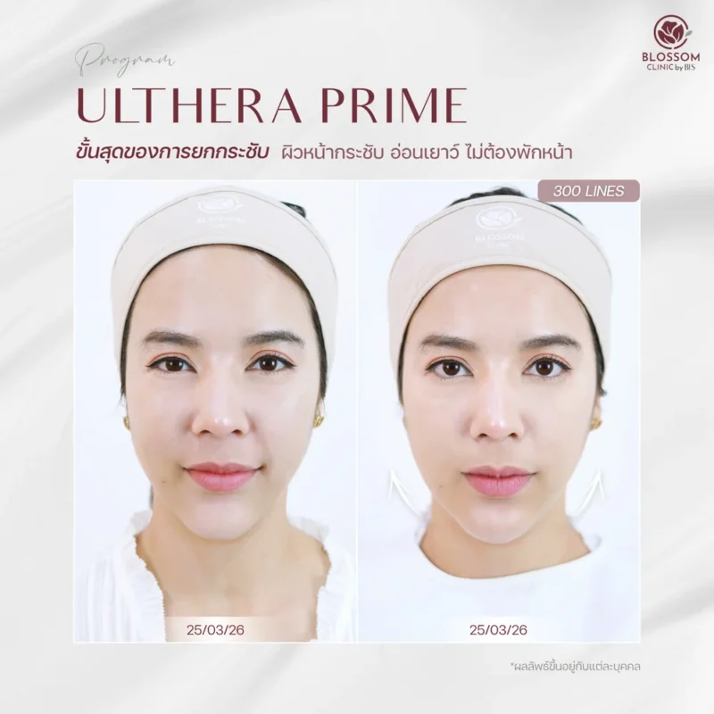รีวิวโปรแกรม Ulthera Prime