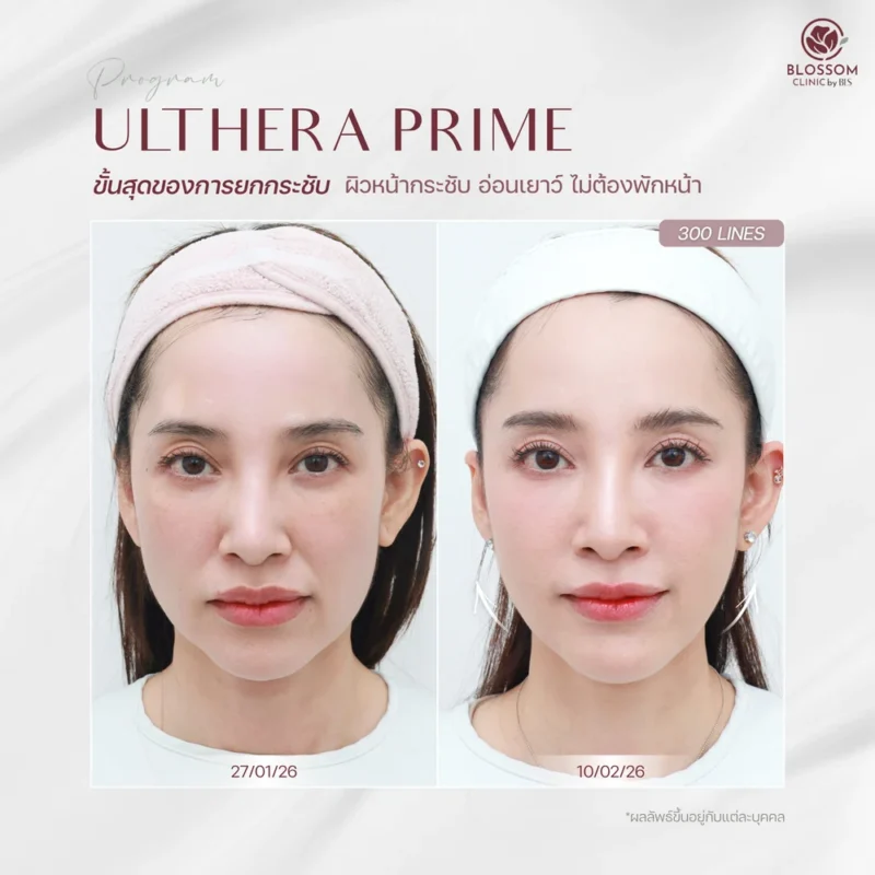 รีวิวโปรแกรม Ulthera Prime