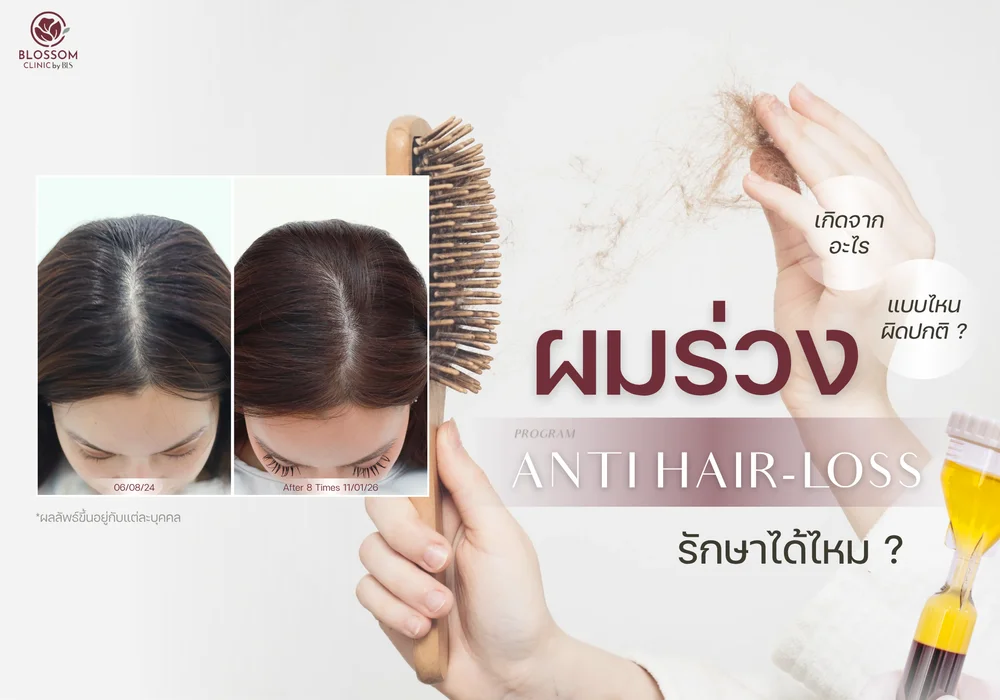 ผมร่วงแบบไหนผิดปกติ? โปรแกรม Anti-Hair Loss รักษาได้จริงไหม?