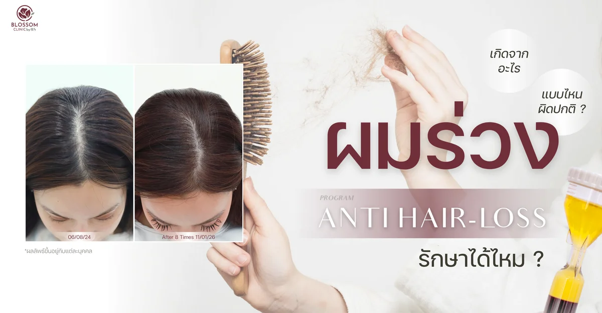 ผมร่วงแบบไหนผิดปกติ? โปรแกรม Anti-Hair Loss รักษาได้จริงไหม?