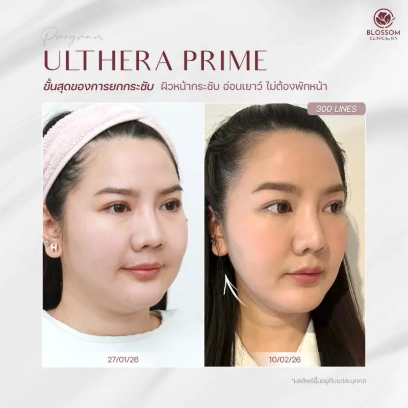 ผลลัพธ์ยกกระชับหน้าด้วยโปรแกรม Ulthera Prime