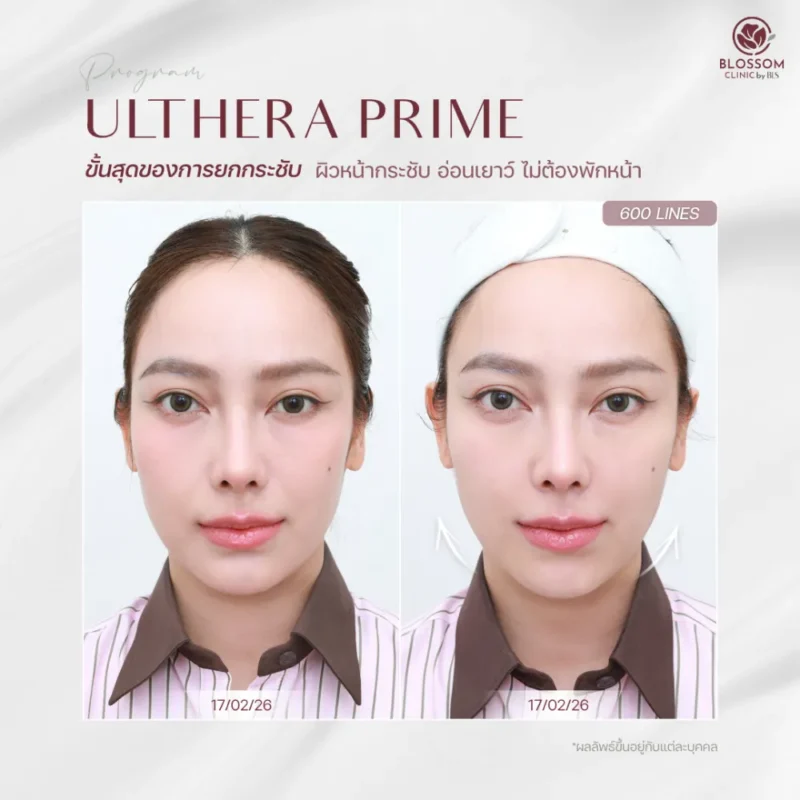 ผิวหน้ากระชับขึ้นหลังทำ Ulthera Prime