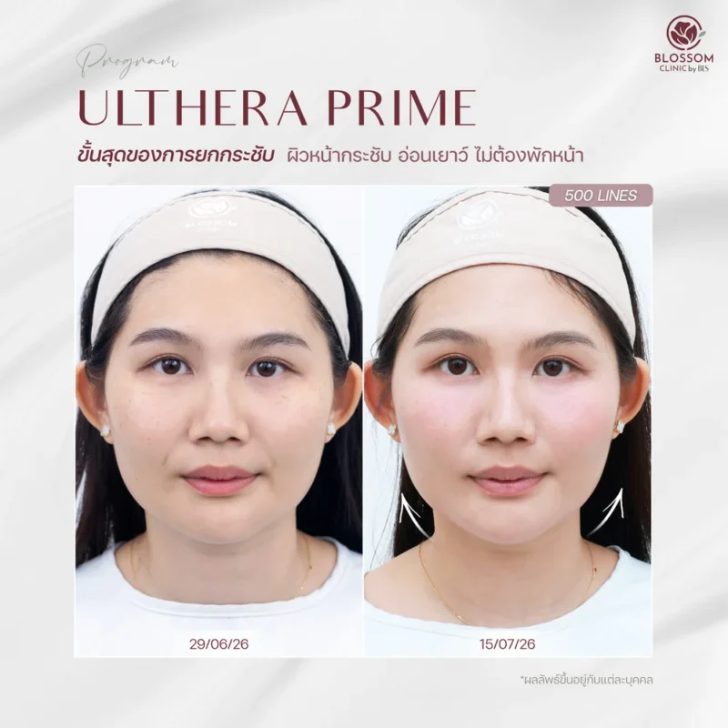 รีวิวโปรแกรม Ulthera Prime