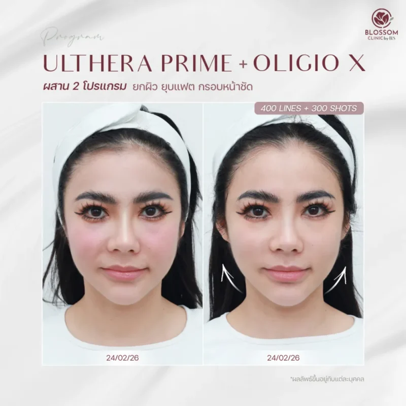 เปรียบเทียบผลลัพธ์ Ulthera Prime