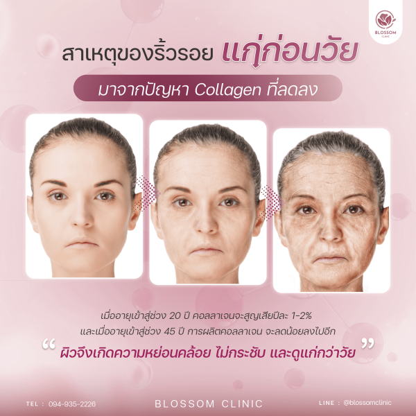 สาเหตุของริ้วรอย มาจาก Collagen ที่ลดลง