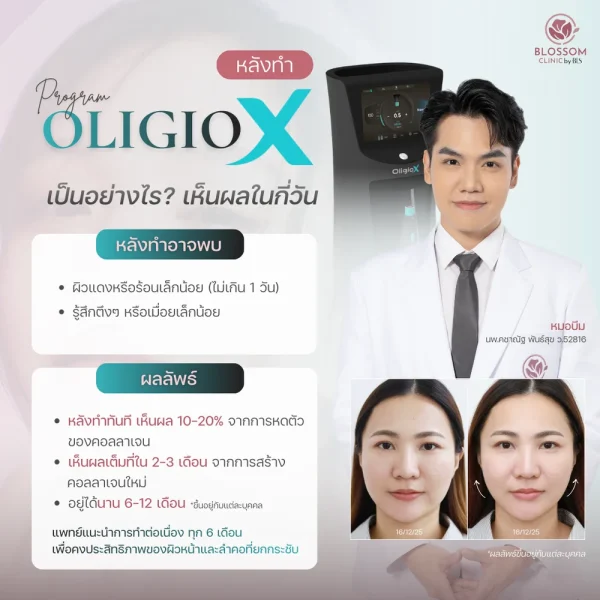 โปรแกรม Oligio x เห็นผลกี่วัน