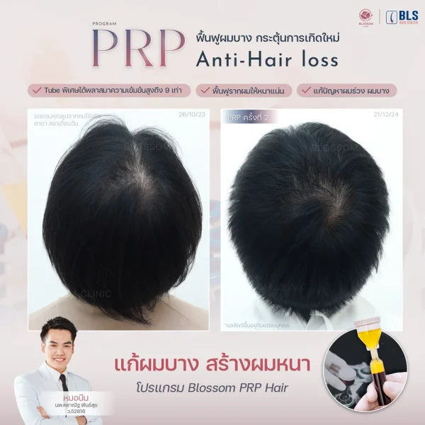 รีวิว PRP Hair ที่ บลอสซั้ม คลินิก