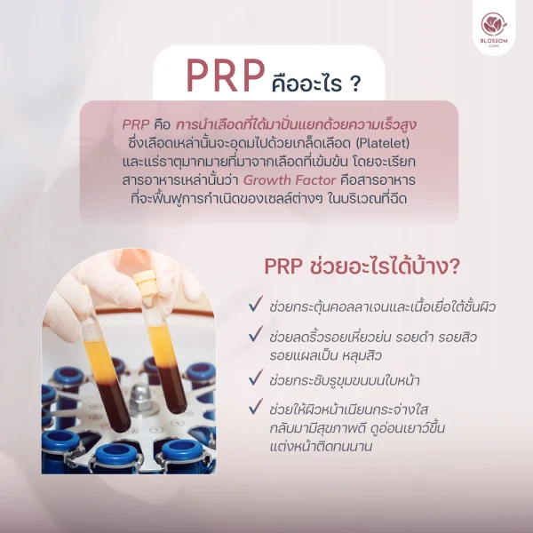 โปรแกรม PRP หน้าใส ช่วยให้หน้าใสไร้สิว จริงหรือ?