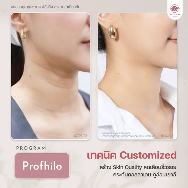 Program Phofhilo แก้ปัญหาเส้นร่องลึกบริเวณลำคอ