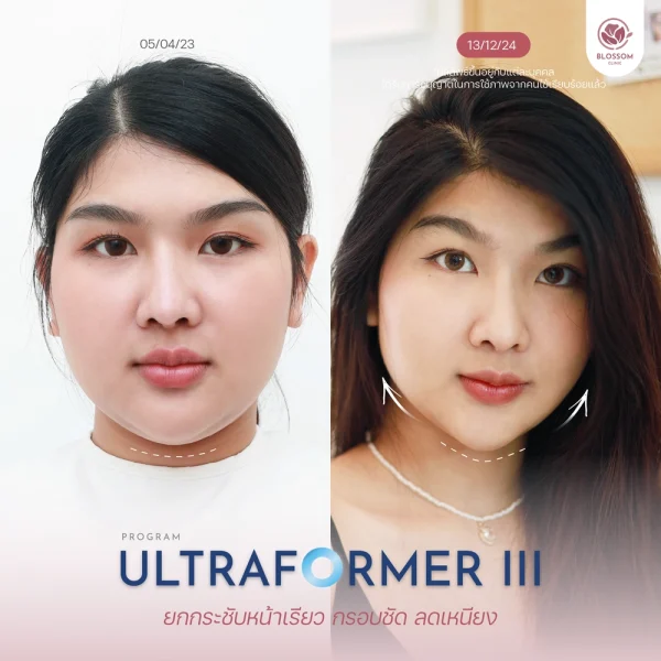 ผลลัพธ์หลังทำโปรแกรม Ultraformer III