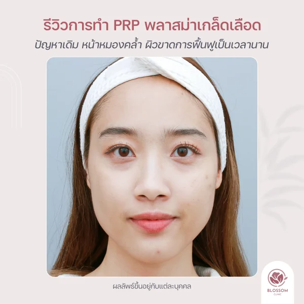 รีวิว ก่อนทำ PRP Skin หน้าใส