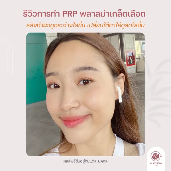 รีวิว หลังทำ PRP Skin หน้าใส