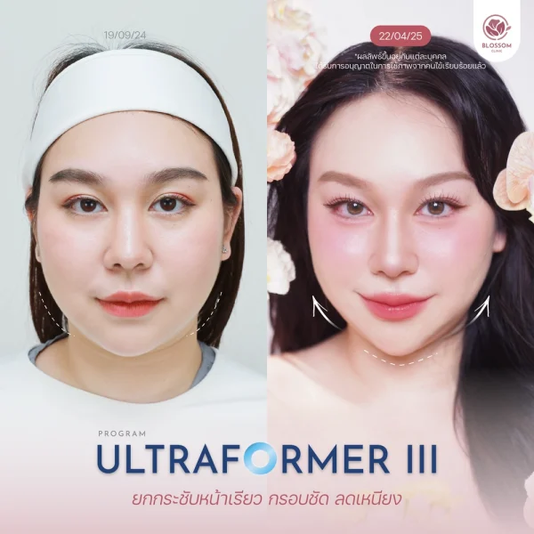 รีวิวผลลัพธ์หลังทำโปรแกรม Ultraformer III