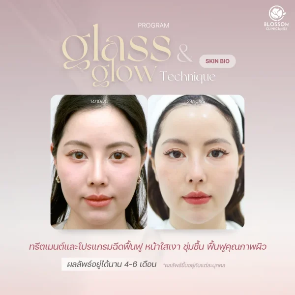รีวิวโปรแกรม Glass & Glow Technique