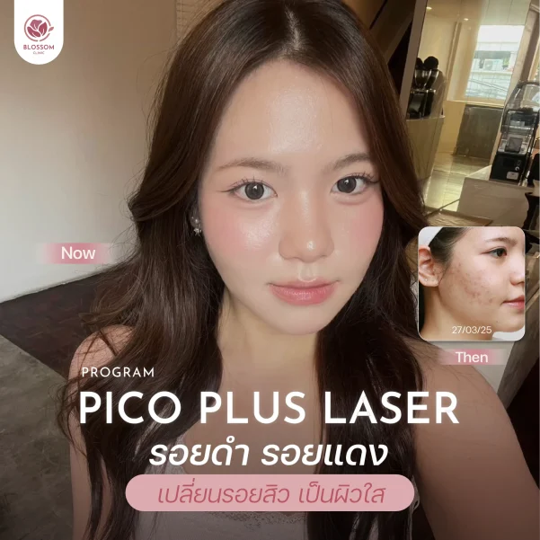 โปรแกรม Pico Laser คืออะไร? เคลียร์จบทุกปัญหาผิว จริงไหม? | เลเซอร์ฝ้า หลุมสิว เลเซอร์รอยสิว เลเซอร์รอยดำ
