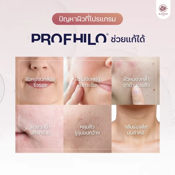 Profhilo แก้ปัญหาใดได้บ้าง?