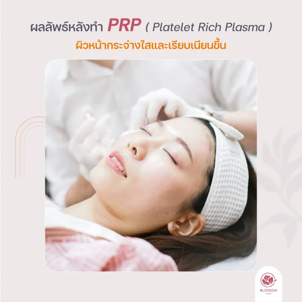 ขั้นตอนการบูสท์ผิวหน้าใส ด้วย PRP ช่วยให้ผิวกระจ่างใสขึ้น