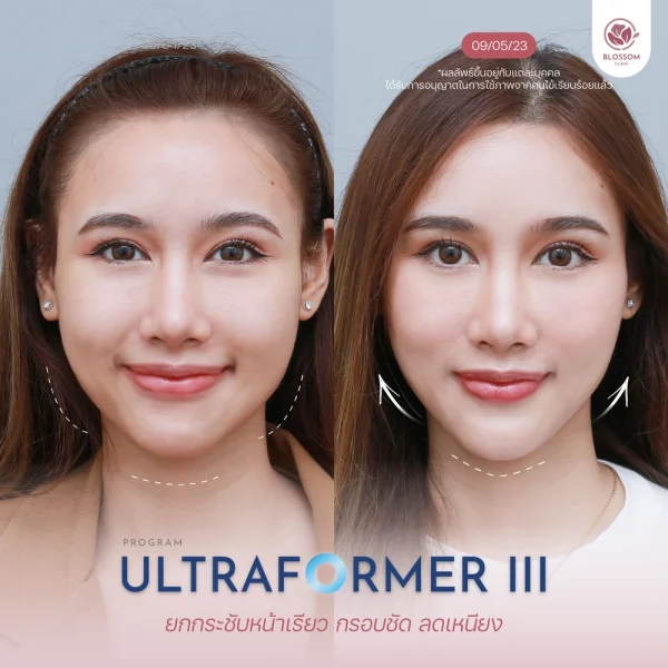 Ultraformer III เหมาะกับใคร?