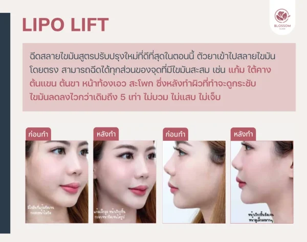 โปรแกรม Lipo Lift