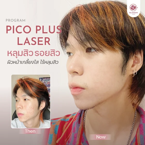 โปรแกรม Pico Laser กำจัดหลุมสิว รอยสิว อย่างได้ผล