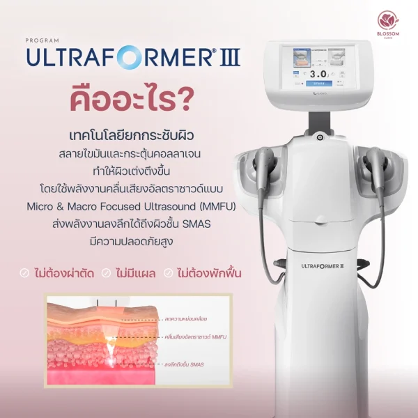 Ultraformer III คืออะไร